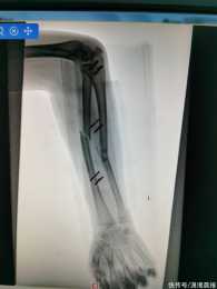 長沙12歲男孩玩單槓致手骨折，裹著紙板膠帶送診，醫生誇讚：做得對