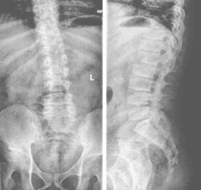「影像拾遺」晚髮型脊椎骨骺發育不良影像診斷