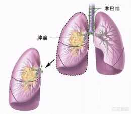 奧西替尼聯合吉非替尼可能會延緩肺癌獲得性耐藥的出現