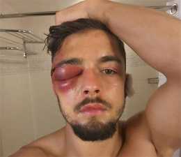 拳擊手都不容易！耳朵被咬傷，下巴被打碎，眼睛腫成鹹鴨蛋