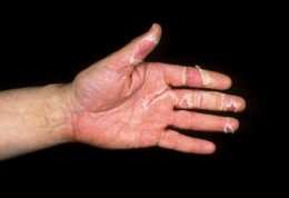 手蛻皮代表著什麼問題，最常見的原因就這些，預防重於治療
