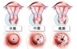貝安健康：宮頸糜爛會影響精子活動力嗎？