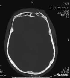 一文掌握丨急診顱腦CT常見的八種疾病