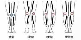 X型腿、O型腿、腿不直的女人，你該如何穿搭？