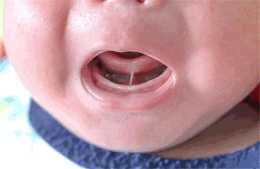 寶寶學不會這幾個發音，家長要小心，可能是“舌繫帶短”